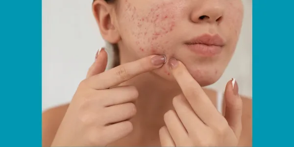 Acne Scar & Spot Treatment