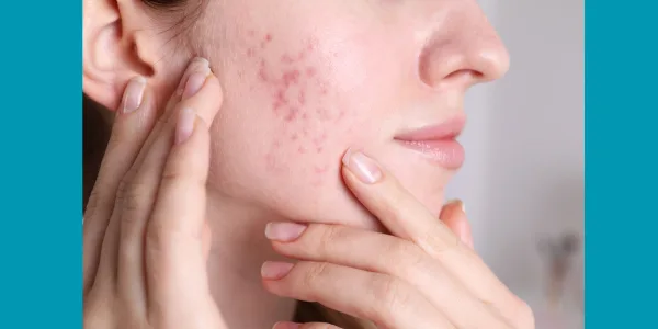 আমাদের অত্যাধুনিক 'Acne Scar & Spot Treatment' কেন আপনার ত্বকের জন্য সেরা সমাধান?