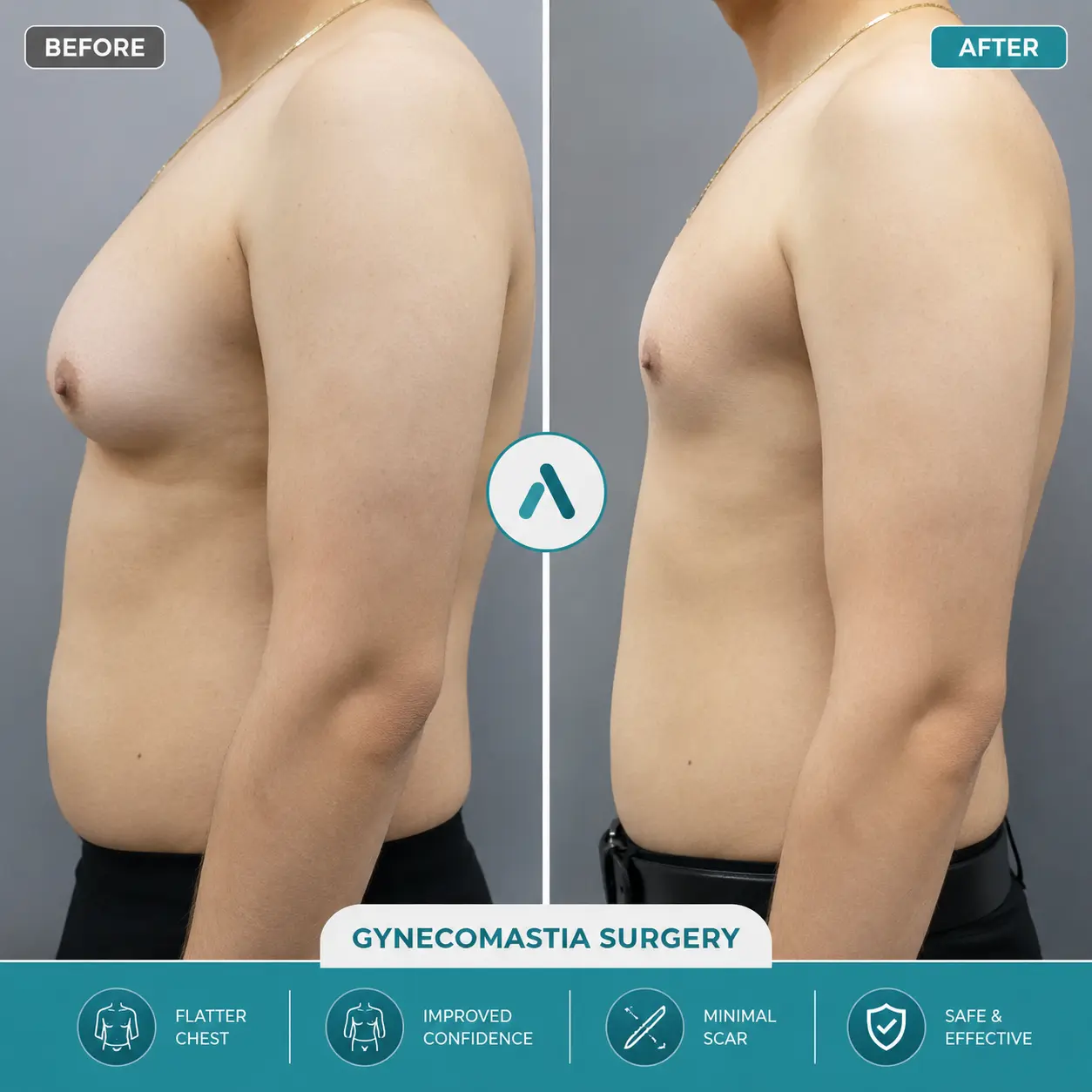 Gynecomastia Surgery