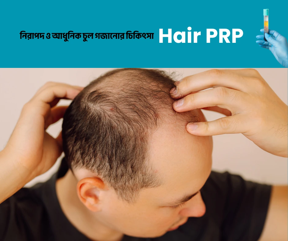 চুল পড়া সমস্যায় -  Hair PRP Therapy