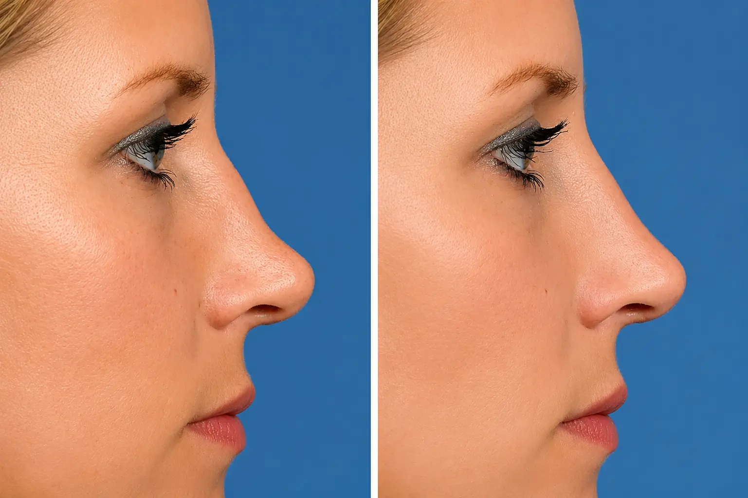 Nose Filler সার্ভিসের মাধ্যমে নাকের আকৃতি নিখুঁত ও আকর্ষণীয় করুন